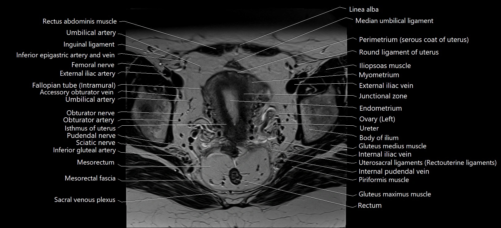 Axial cross sectional anatomy of female pelvis (MRI 3T) image 20.webp